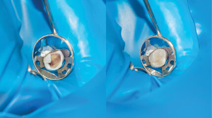 using composite bonding to repair a decayed tooth