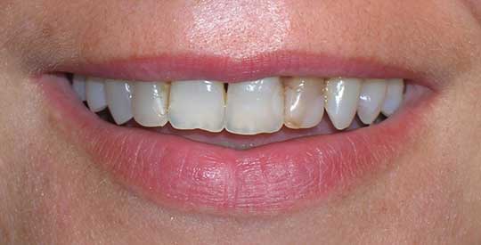 stained teeth needs cosmetic dentistry